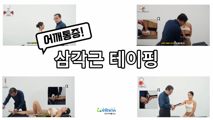 어깨통증이 있을때는 삼각근 테이핑!