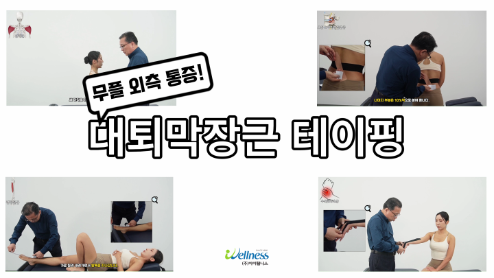 무릎 외측 통증! 대퇴막장근 테이핑